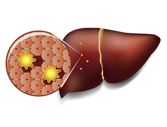 高血脂|吃土豆会导致血脂升高?高血脂出现我们是如何观察到的?