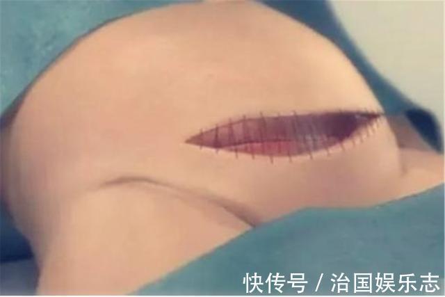 宝妈|九张剖腹产手术全过程图片,那些说生孩子容易的人好好看看