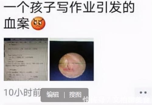 鼓膜|因为写作业,孩子被打到耳鼓膜穿孔?能治好吗?医生:别太紧张