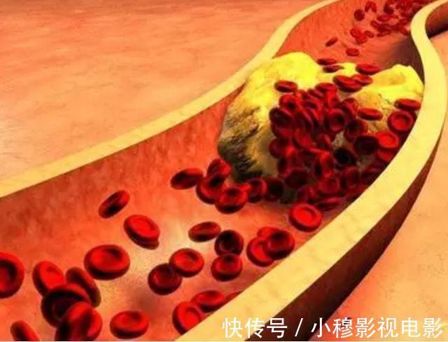 鸡蛋黄|这5种食物虽美味,胆固醇含量或许比较高,高血脂患者尽量少吃