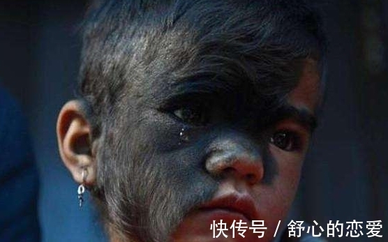 长相|9岁女孩因长相奇怪被称为“半脸怪物”,术后让人大开眼界