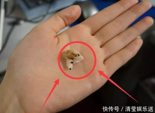 为啥有人耳屎又湿又油,有人却“干巴巴”的?3个原因,早自检!