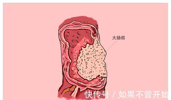 大便|一天发现3例晚期肠癌，医生很痛心，告诉大家：肠癌其实最好预防