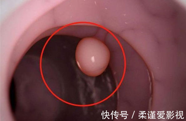 病理性|年过50想长寿,要留心身上的4个“小凸起”,离癌症近的人才会有