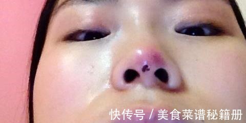 自然风格 隆鼻术后假体穿透鼻尖，这也太吓人了！