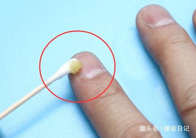 红霉素软膏|红霉素软膏除了药用,还有5个妙用也很棒,叮嘱家人知道,很实用