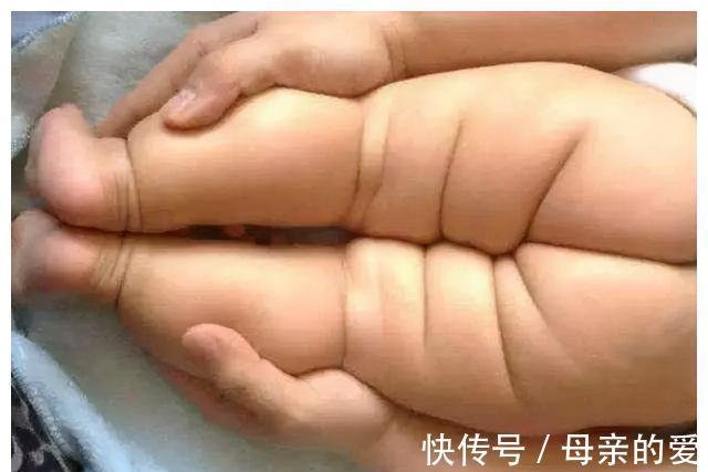 发育性髋关节脱位|宝宝臀纹不对称,家长一定要注意