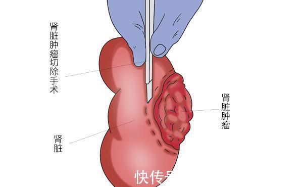 致癌物质|得癌后该忌口的发物，不是猪牛羊，真正不能吃的是3种食物