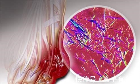 痛风|有痛风，能吃豆腐吗医生送你1条饮食口诀，让尿酸降得又快又好