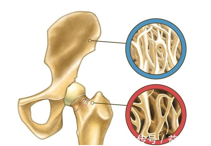 骨小梁|有骨质疏松别总只想着补钙,教你1个方法,不花钱还很简单