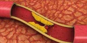 高血脂|这一种粗粮是公认的“降脂冠军”,血脂高的人经常吃,血管通透