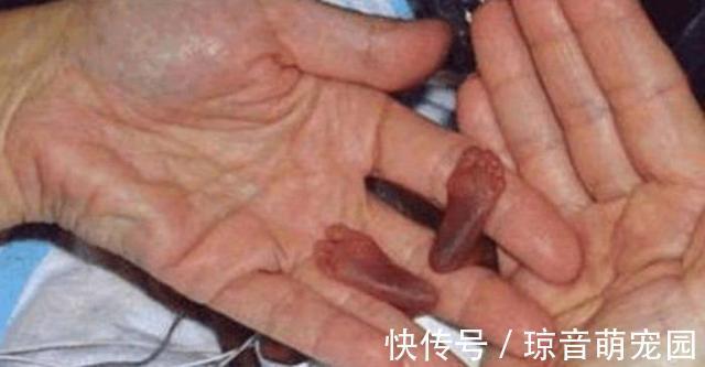 体重|在娘胎里只呆了22周的宝宝,出生时体重仅为245克,世界最小婴儿