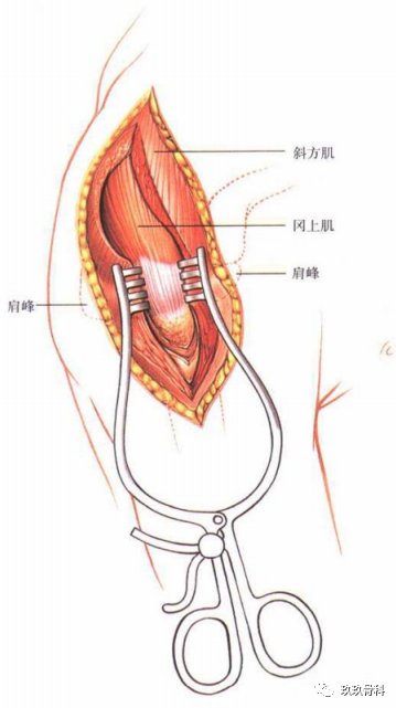 肩关节外侧入路|图文详解 | 肩关节