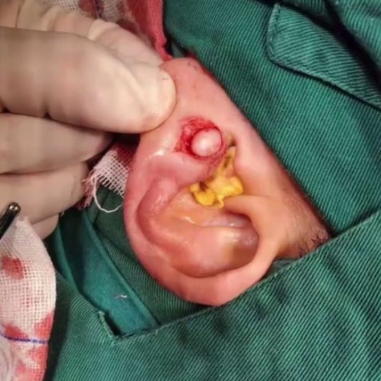 珍珠瘤|女子左耳垂上长了个疙瘩,医院检查后,医生从中取出一颗“珍珠”