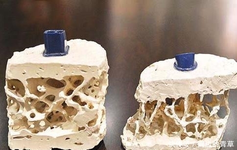 85岁中医研究骨病50年:骨疏松别着急,做好3件事,省去服药