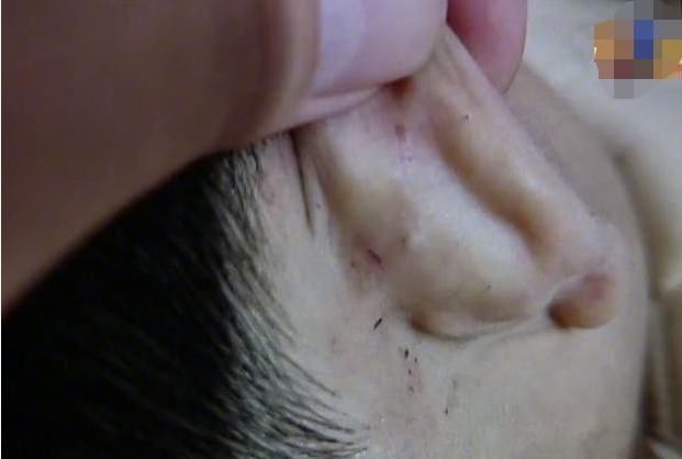 儿子|男孩耳后有伤口,妈妈怀疑是幼儿园小朋友抓伤,但娃的话让她崩溃