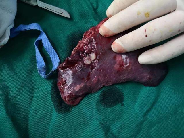 恶性肿瘤|结节越大癌变的可能性越大医生提醒有3种结节一定要切除