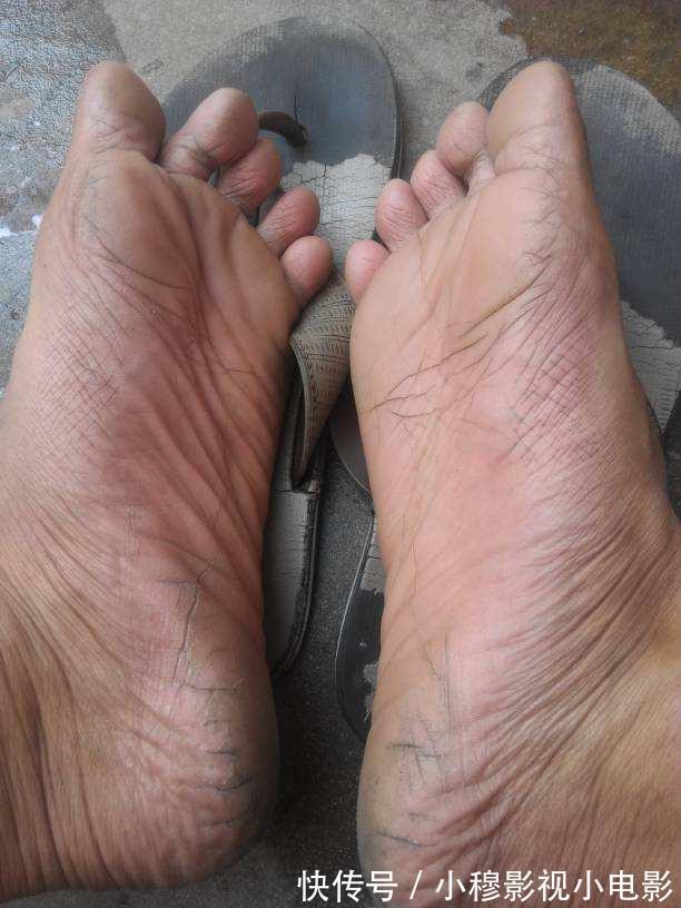 掌心|肝癌多是“拖”出来的，如果双脚有4种迹象，趁早就医，能保命！