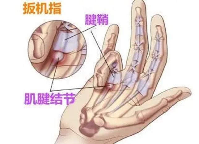 手机|颈椎病、腱鞘炎、视力障碍……人手一个“致残”工具，你也有
