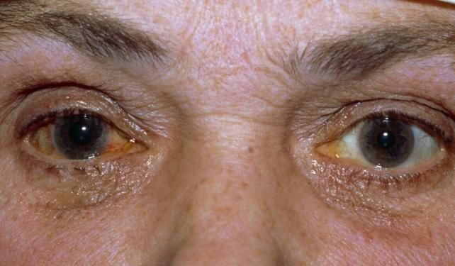 浮肿|眼病出现有信号，眼睛出现5个症状需警惕，赶紧就医检查