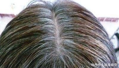 白头发|人的头发为什么会变白?不一定是年龄,知道这几点之后让你白变黑