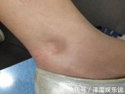 心脏病|心脏好不好,腿脚不会骗你!若腿脚有此三表现,恭喜,心脏还不错