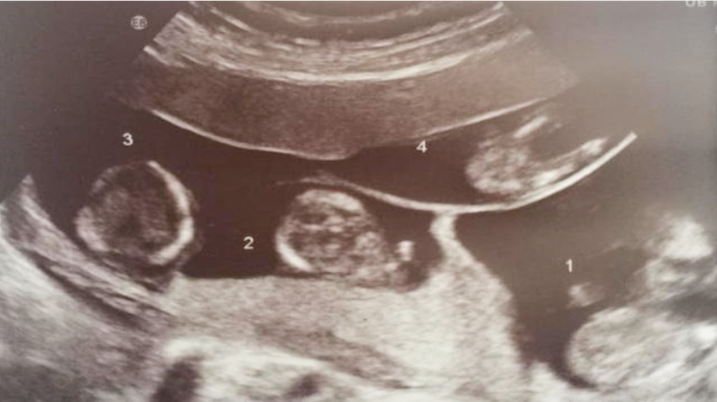 诞下|妈妈异卵四胞胎,诞下双儿双女,网友“异卵四生,太幸运了!”