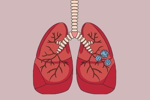 结节|结节、息肉、囊肿、增生，哪个是癌症“先兆”？一文给你说清