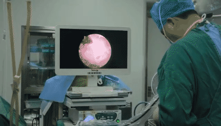 技术|医院再次成功开展内镜下椎间盘髓核摘除术治