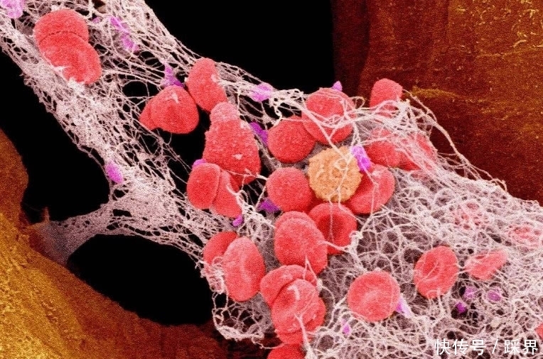 动脉硬化|血脂升高别害怕!每天吃这几种食物,帮你疏通血管,预防动脉硬化