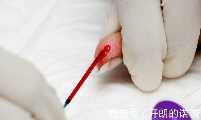 服用|做血脂检查应该注意哪几点检查单的4个指标,或不容忽视