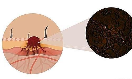 良性肿瘤|为何有些癌症患者,手术后还是会复发是治疗的不彻底吗
