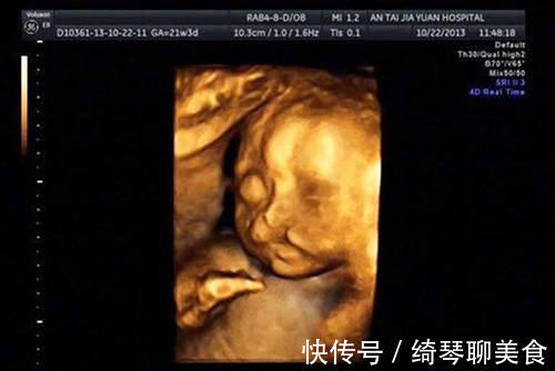 彩超|被宝宝的四维彩超照丑哭了?不是医生技术不好,而是有客观原因的
