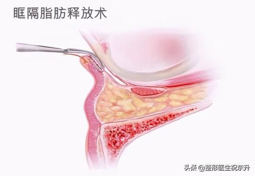 别随便做“眶隔脂肪释放”祛眼袋手术，否则会“后悔”？