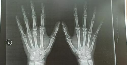 骨骺线|男孩十二岁就变声了,身高一米六五,还能长高吗?