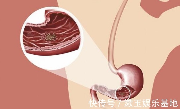 胃痛|胃癌早期不痒不疼，饭后若有以下4个“异常”，多半需要就医了