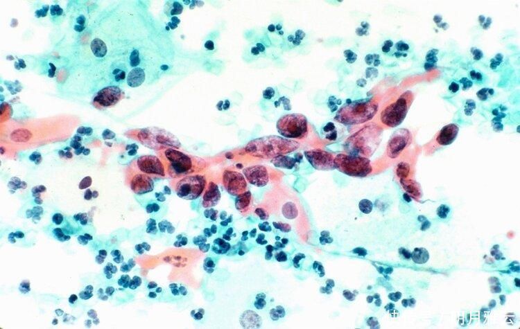 院士|“吞口水就像是吃碎玻璃渣子”,说到癌痛,92岁院士落泪了