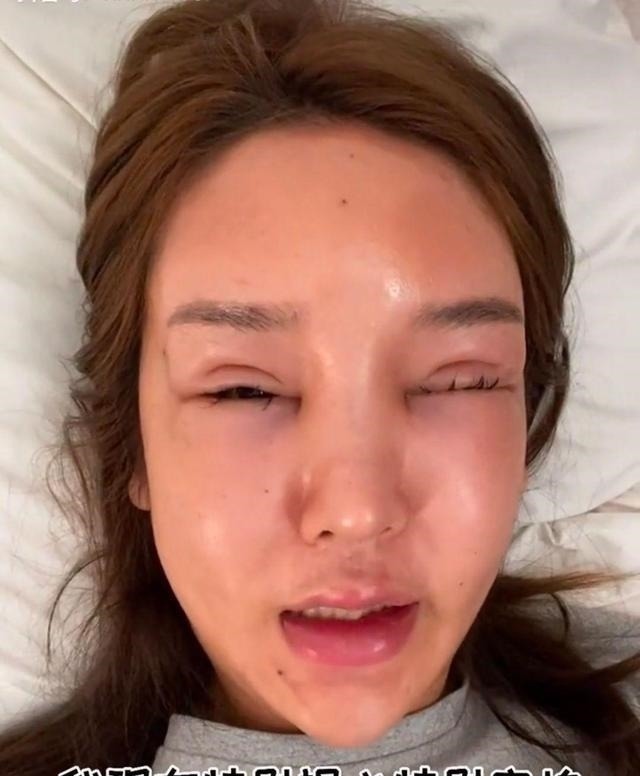 光额头 8年的整形手术花费了100多万,光额头就打了200多支玻尿酸