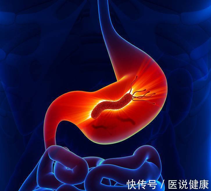 幽门螺旋杆菌|感染幽门螺杆菌后,别大意了,推荐这3种方法,或能消除