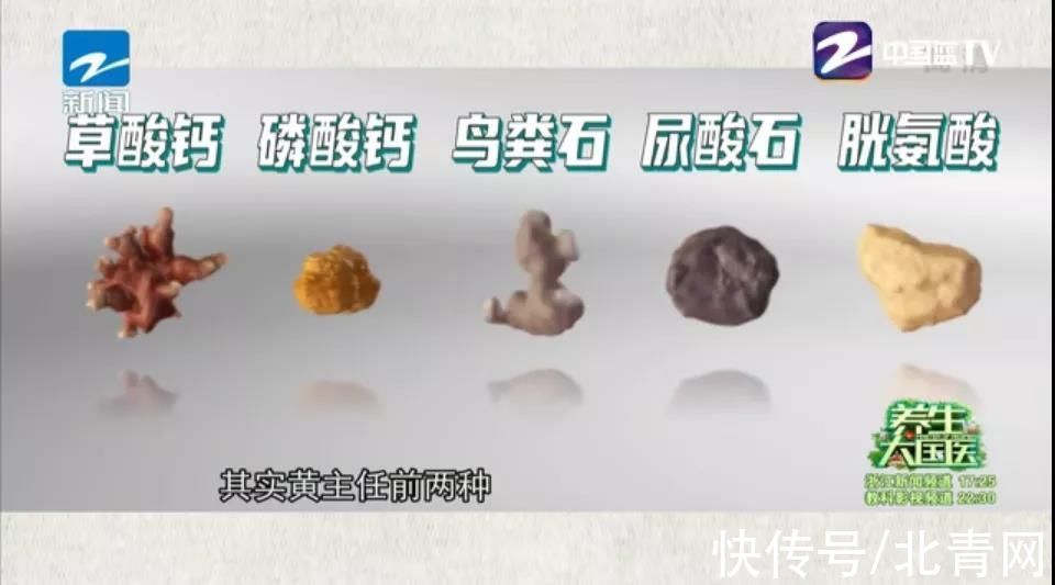 肾绞痛|肾结石究竟是如何形成的？医生劝告：4个诱因及时避开，切莫贪嘴多吃