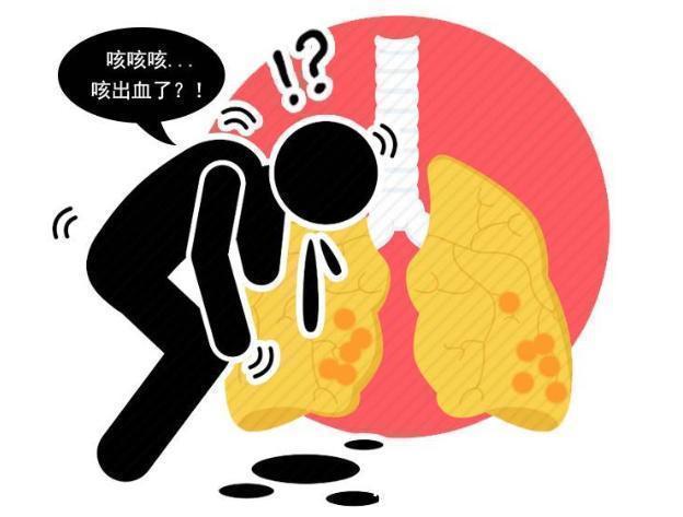 喉返神经|肺癌除了胸痛外，若还有这4个表现，警惕癌症已到中晚期