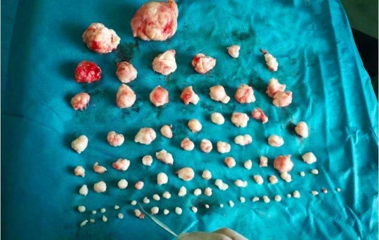 粘膜下肌瘤|遇到子宫肌瘤一定要切吗？4种方法可以让子宫肌瘤自行缩小