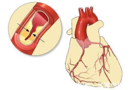 医生|心肌缺血6个症状不要忽略,医生提醒做好5个措施,心脏才安全