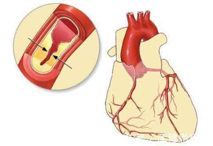 医生|心肌缺血6个症状不要忽略，医生提醒做好5个措施，心脏才安全