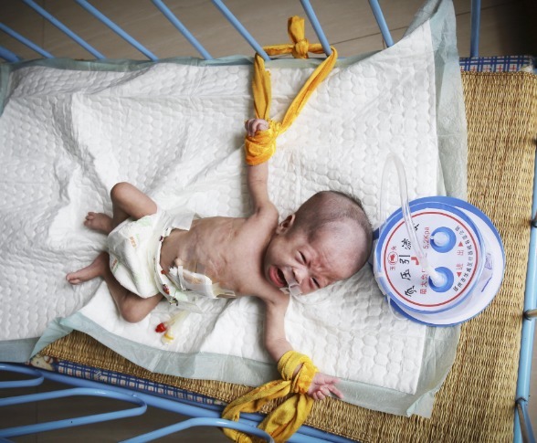 管子|妈妈生下双胞胎女儿,看到大女儿时妈妈发呆,只能用绳子绑住