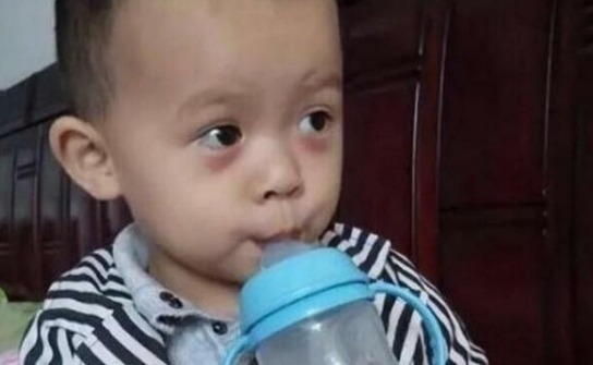 舌苔|5岁男童长期积食不在意,拖成“疳积”,医生:家长太无知了