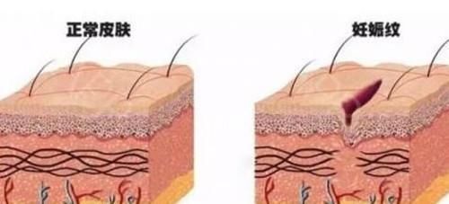 孕妇|妊娠纹是怎么产生的?网友用塑料袋像大家展示,简直不要太形象