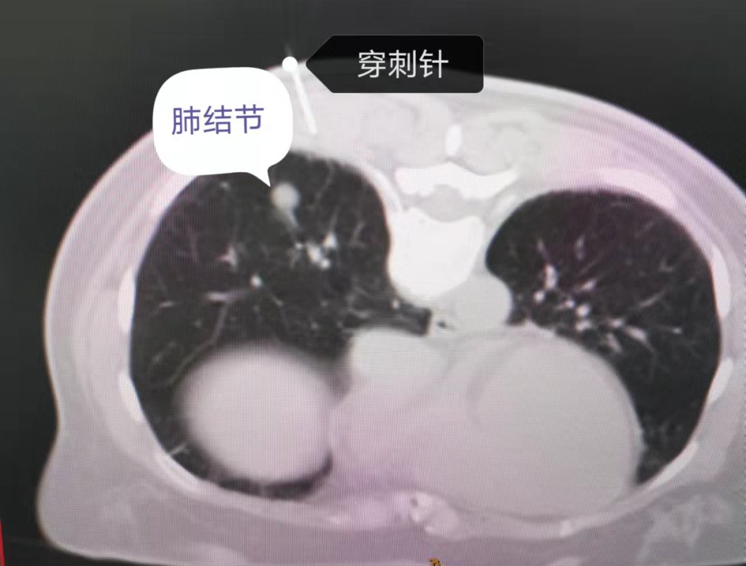 胸腔镜|【技术服务】术前CT引导下美兰定位，汶医成功开展精准肺结节切除术