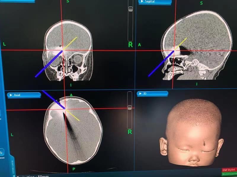 外伤|吓人！1岁女婴颅内取出4厘米断刀，医生提醒