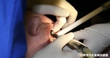 拔牙|男子医院拔出一颗牙,几乎拔掉了自己一条命